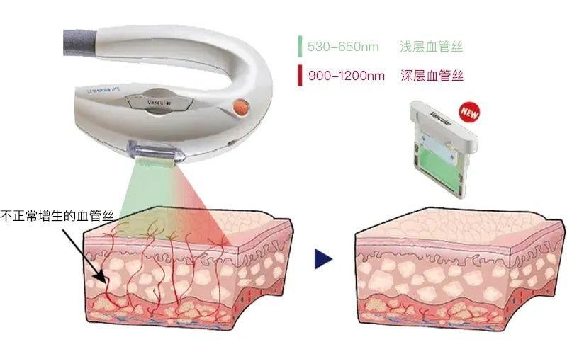 Vascular血管滤光片作用