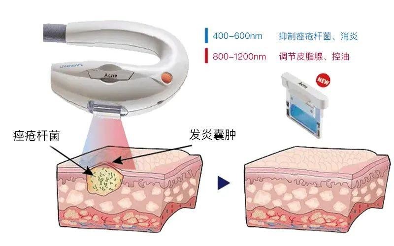 Acne痤疮滤光片作用