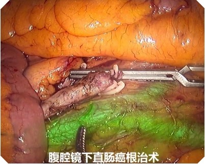 腹腔镜下直肠癌荧光效果